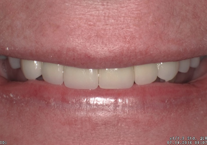 smile makeover results
