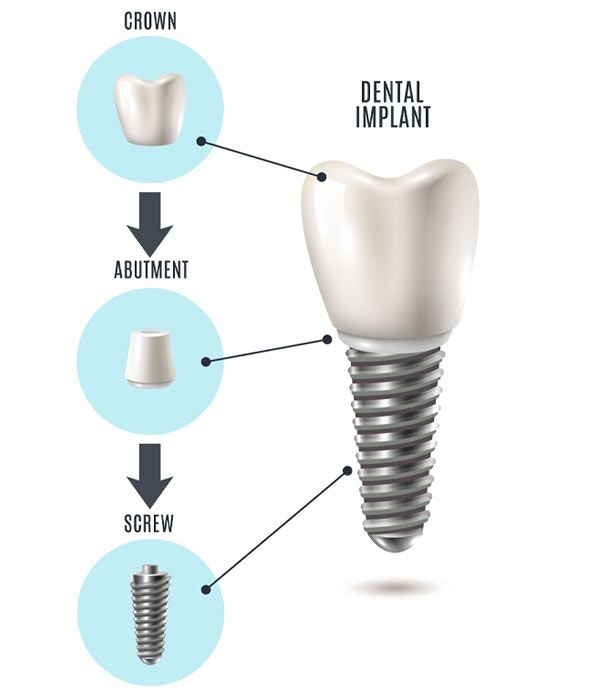 parts of a dental implant