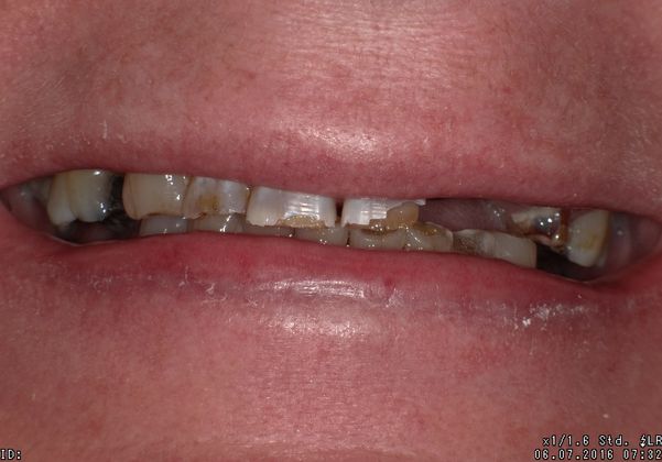 Case 3 before dental implant procedure