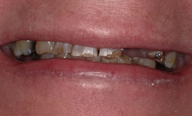 Case 3 before dental implant procedure