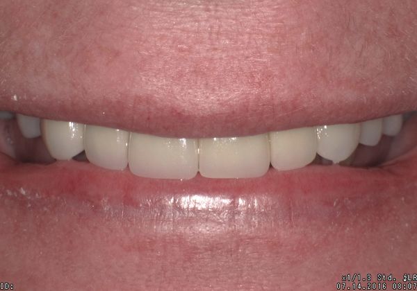 Case 3 after dental implant procedure