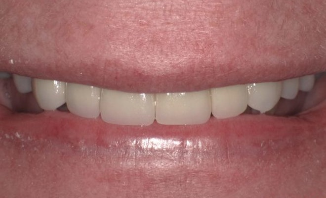 Case 3 after dental implant procedure