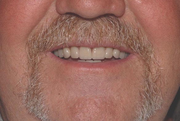 Man smiling after getting dentures
