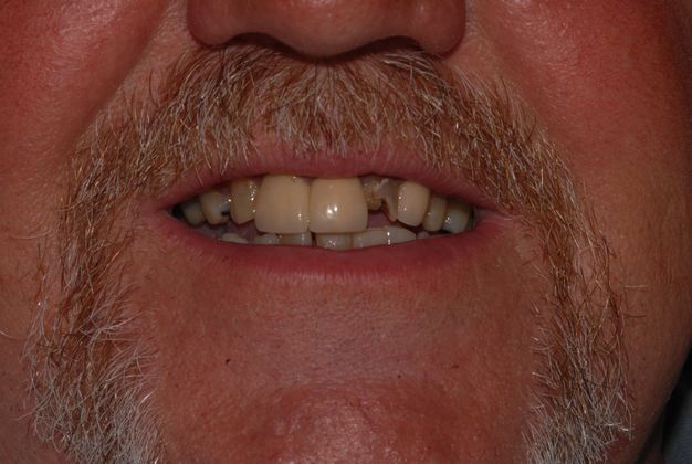 Man with damaged teeth and an uneven smile