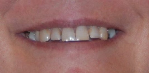 smile with some discoloration, gaps, and staining