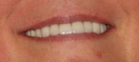 sparkling white smile with even teeth, no gaps, or discoloration
