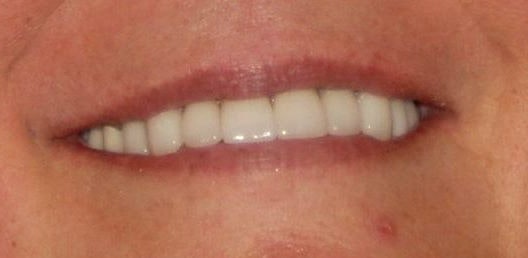 sparkling white smile with even teeth, no gaps, or discoloration