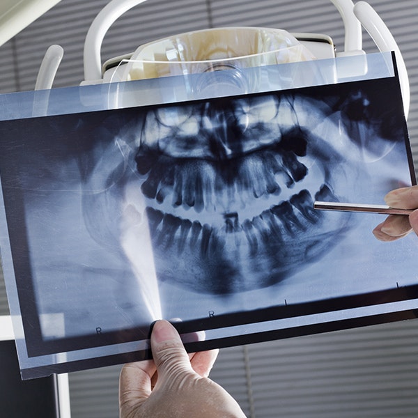 Dental x-rays