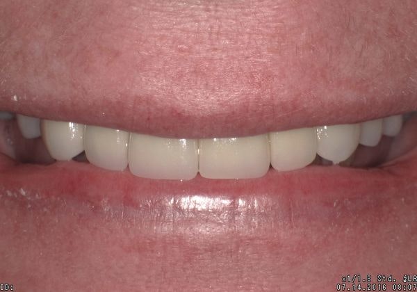 after cosmetic dentistry