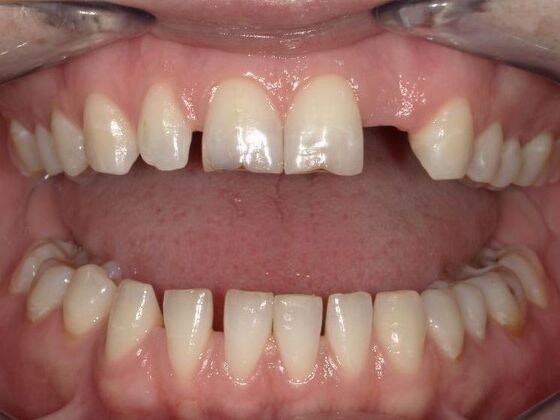 Before Dental bridge