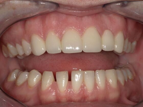 After Dental bridge