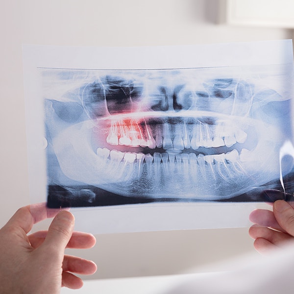 Patient looking at dental x-rays with dentist