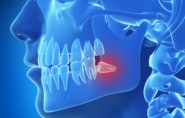 Illustration of a complex wisdom tooth case