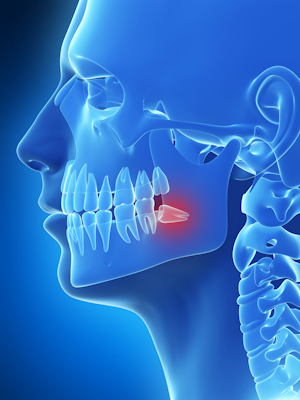 Illustration of a complex wisdom tooth case