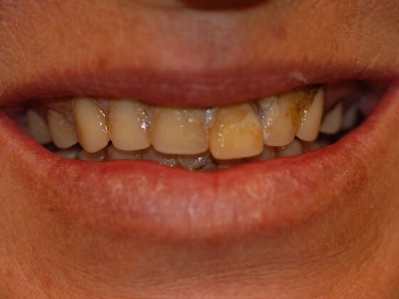 Dental Solutions patient before cosmetic dentistry