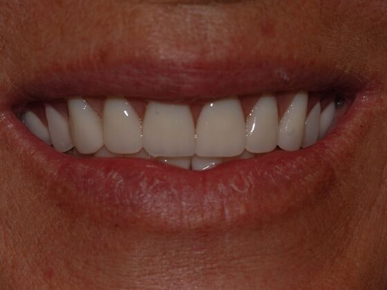 Dental Solutions patient after cosmetic dentistry