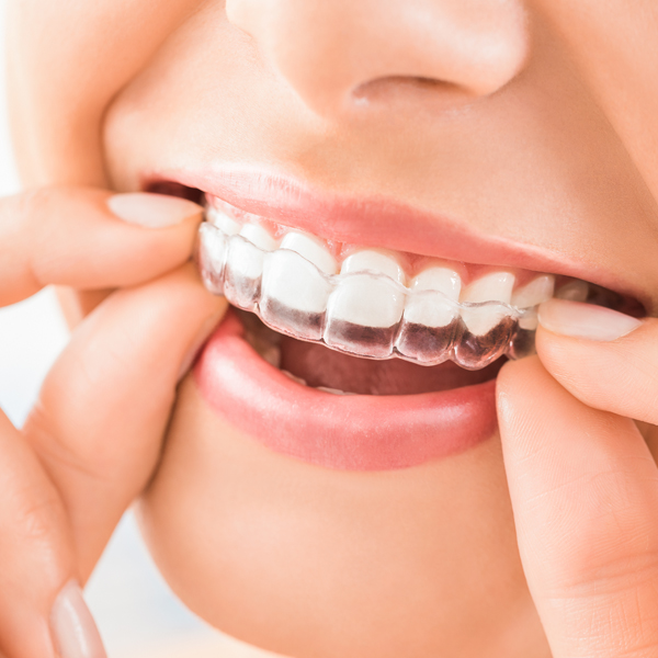 smile with Invisalign aligners