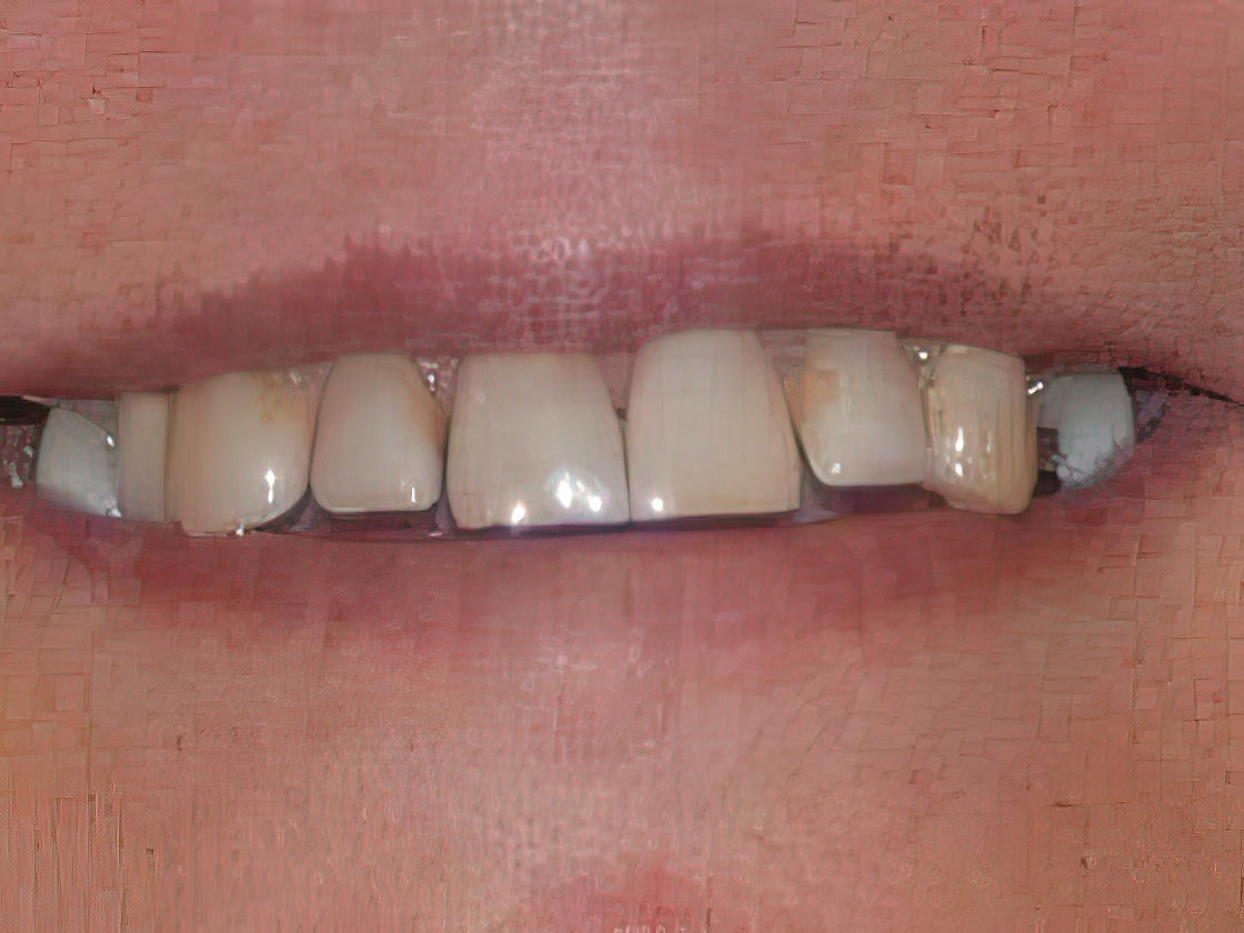 smile with some discoloration, gaps, and staining