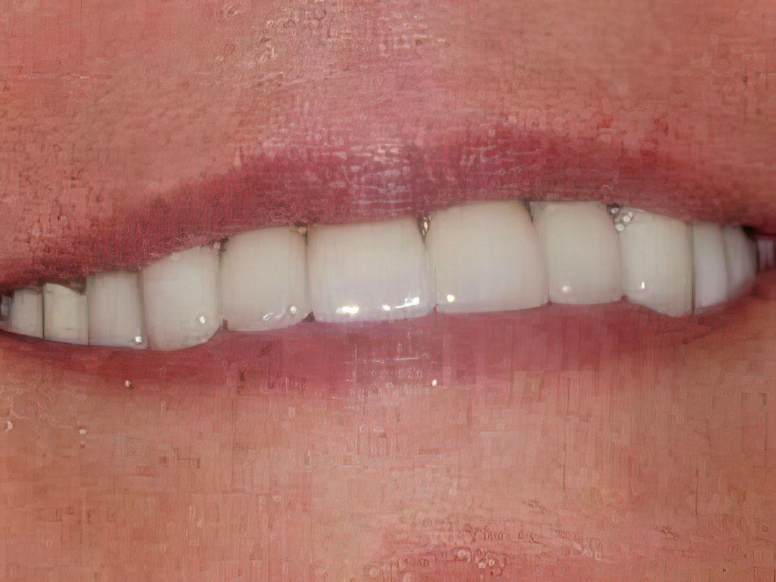 white smile with even teeth, no gaps, or discoloration