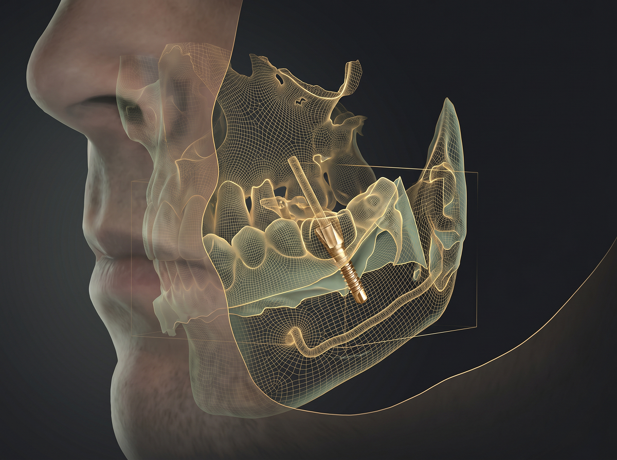3D guided implant planning image