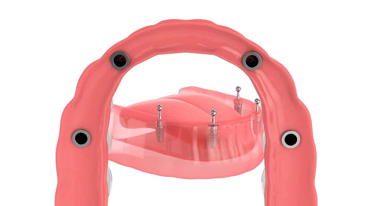 implant supported dentures 3d graphic