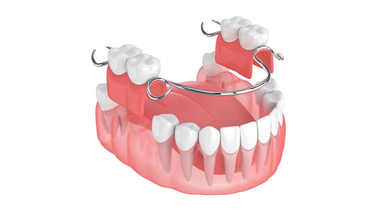 partial dentures 3d image