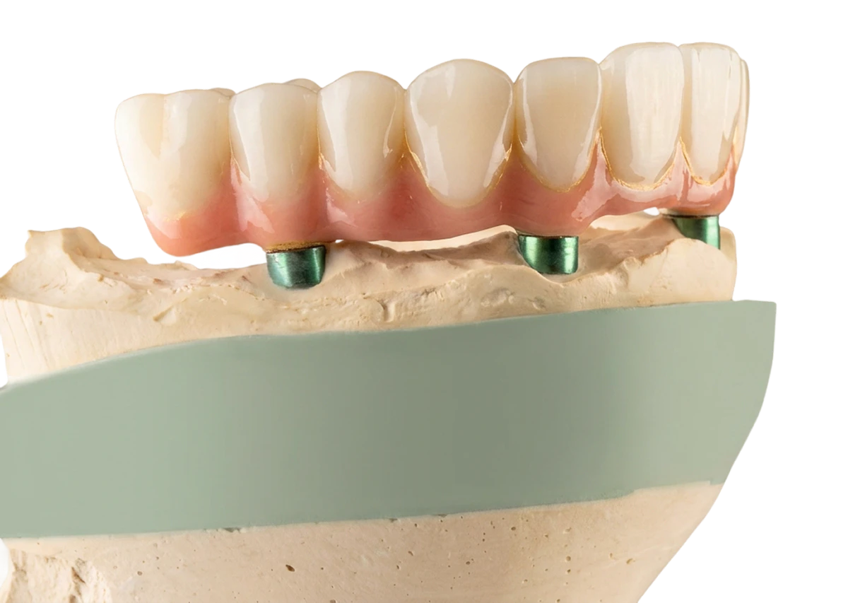 implant-supported dentures