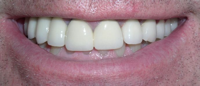 Staten Island Aesthetic & Implant Dentist patient after implant restoration