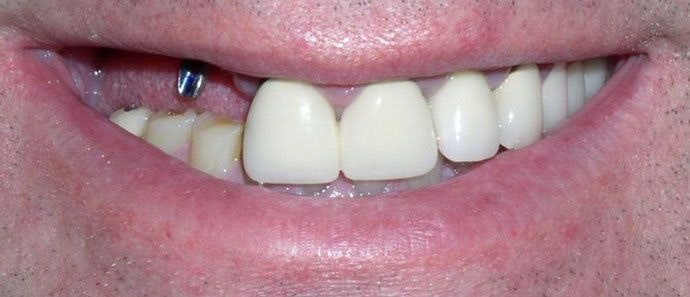 Staten Island Aesthetic & Implant Dentist patient before implant restoration