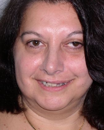 uneven, gapped smile before dental implants