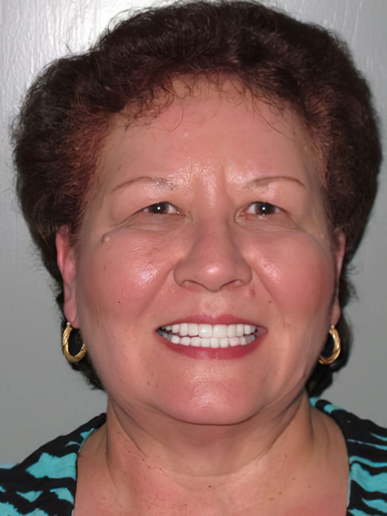 veneers patient