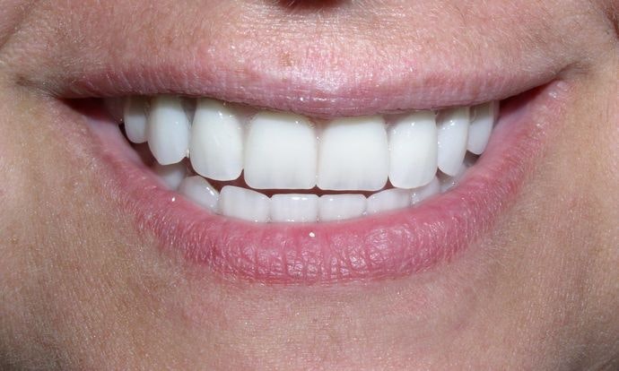 After Full Mouth Reconstruction