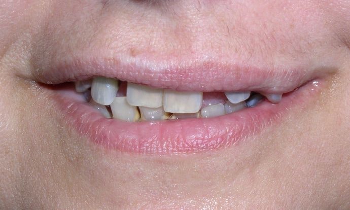 Before Full Mouth Reconstruction