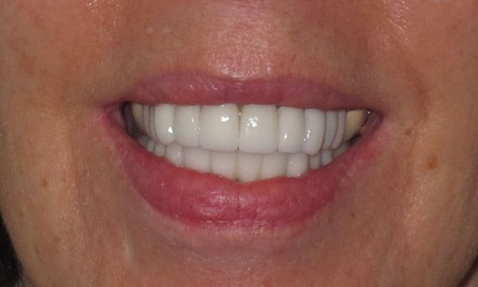 Staten Island Aesthetic & Implant Dentist Patient After Cosmetic Dentistry