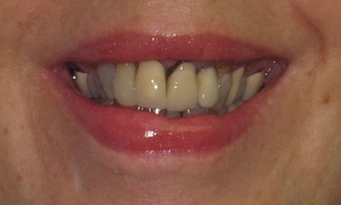 Staten Island Aesthetic & Implant Dentist Patient Before Cosmetic Dentistry