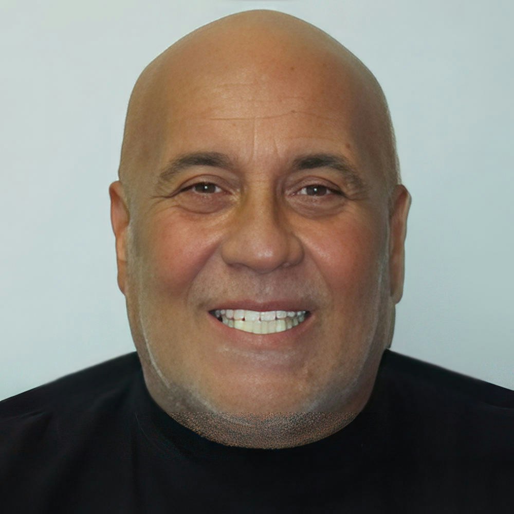 Real patient after smile makeover