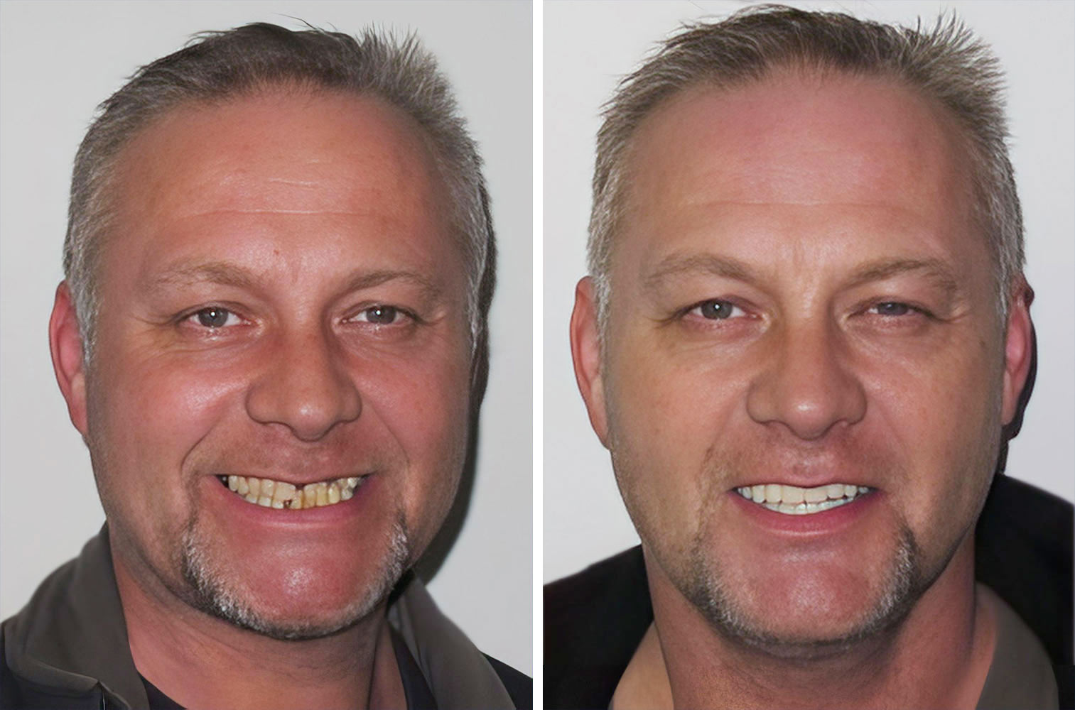 Before and after full mouth reconstruction