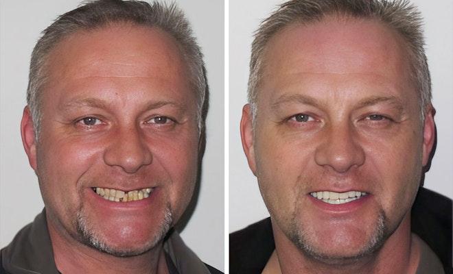 Before and after full mouth reconstruction