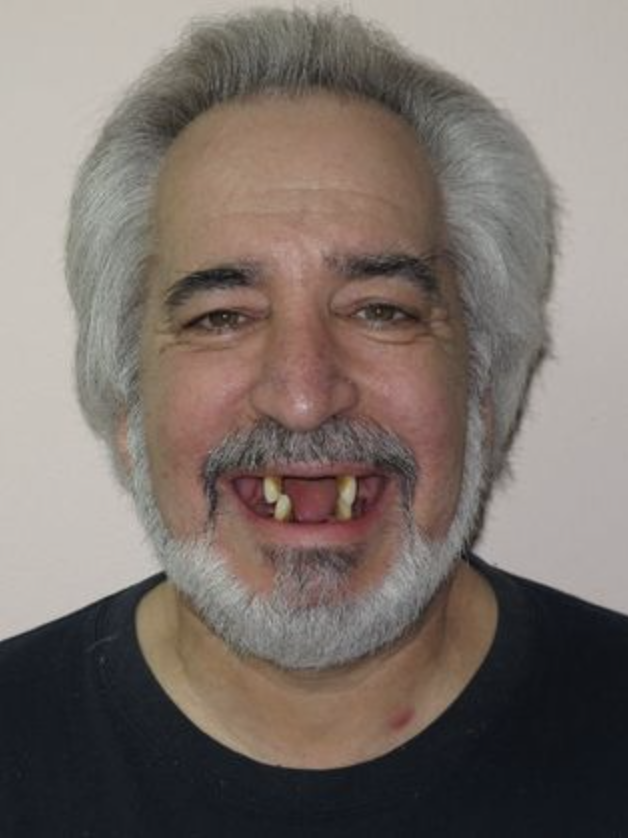 Before implant dentures