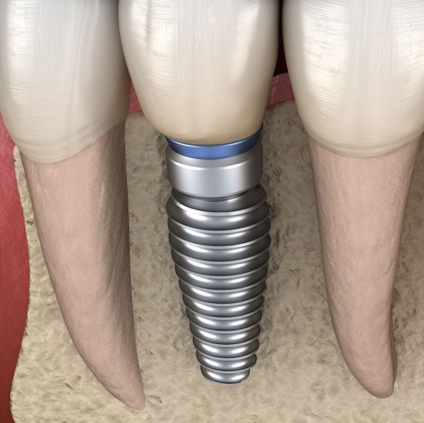 Dental implant and restoration among natural teeth