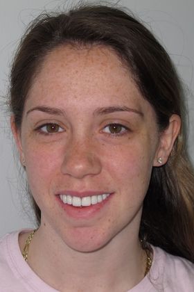 Staten Island Aesthetic & Implant Dentist patient after veneers