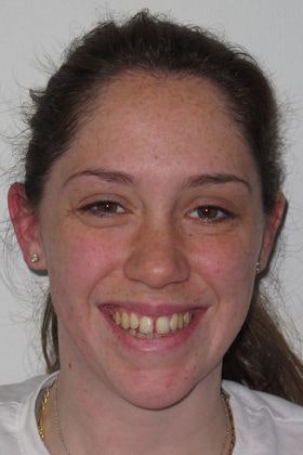 Staten Island Aesthetic & Implant Dentist patient before veneers