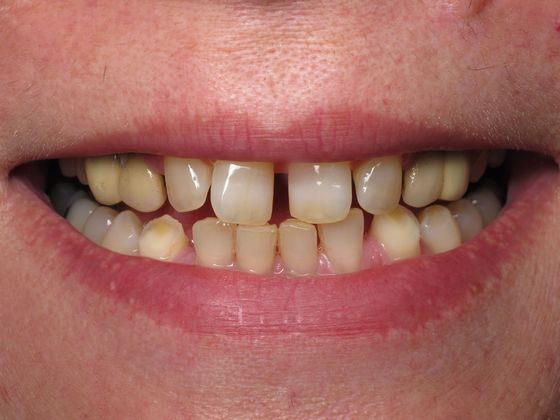 Staten Island Aesthetic & Implant Dentist patient before veneers