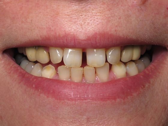 Staten Island Aesthetic & Implant Dentist patient before veneers