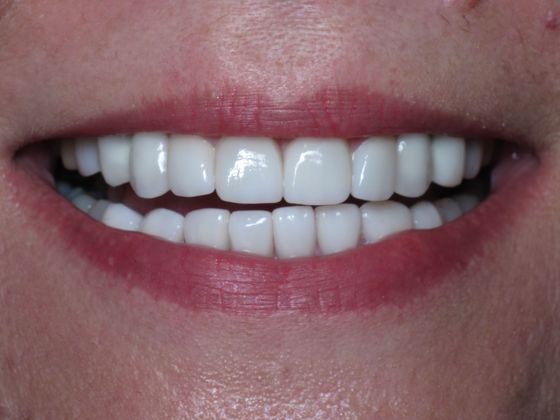 Staten Island Aesthetic & Implant Dentist patient after veneers