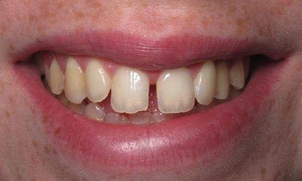 patient before veneers