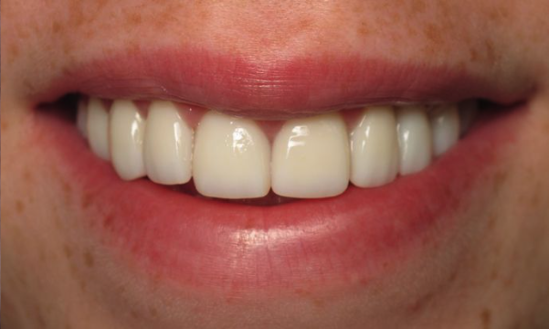 patient after veneers