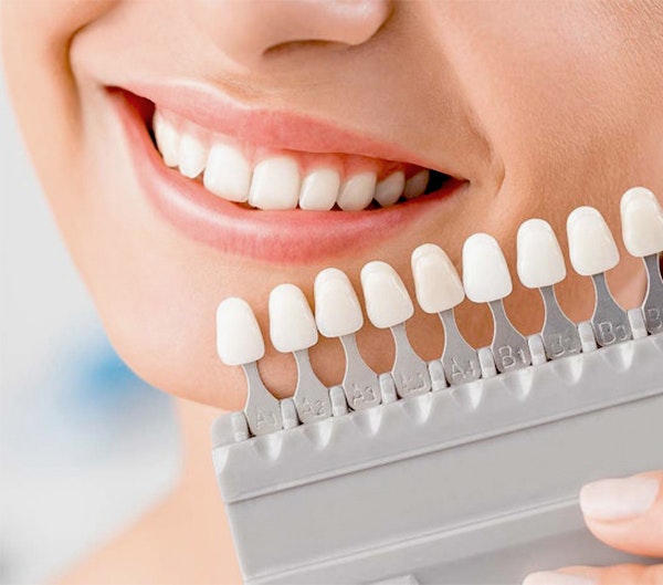 Smiling woman with veneers