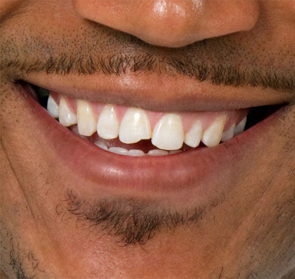 Smiling man with chip in tooth