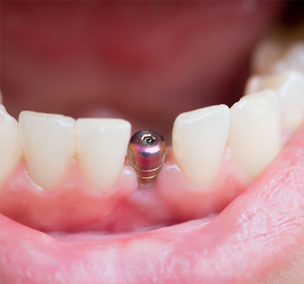 Dental Implant